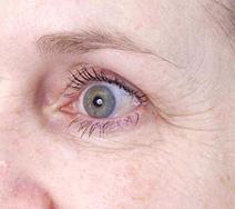Botulinum toxin Before